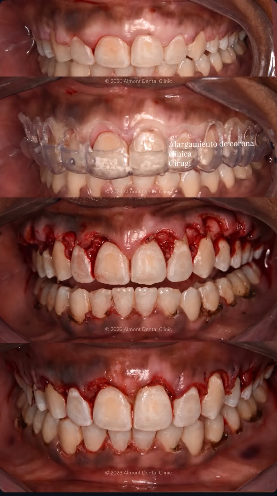 Guided surgical crown lengthening
