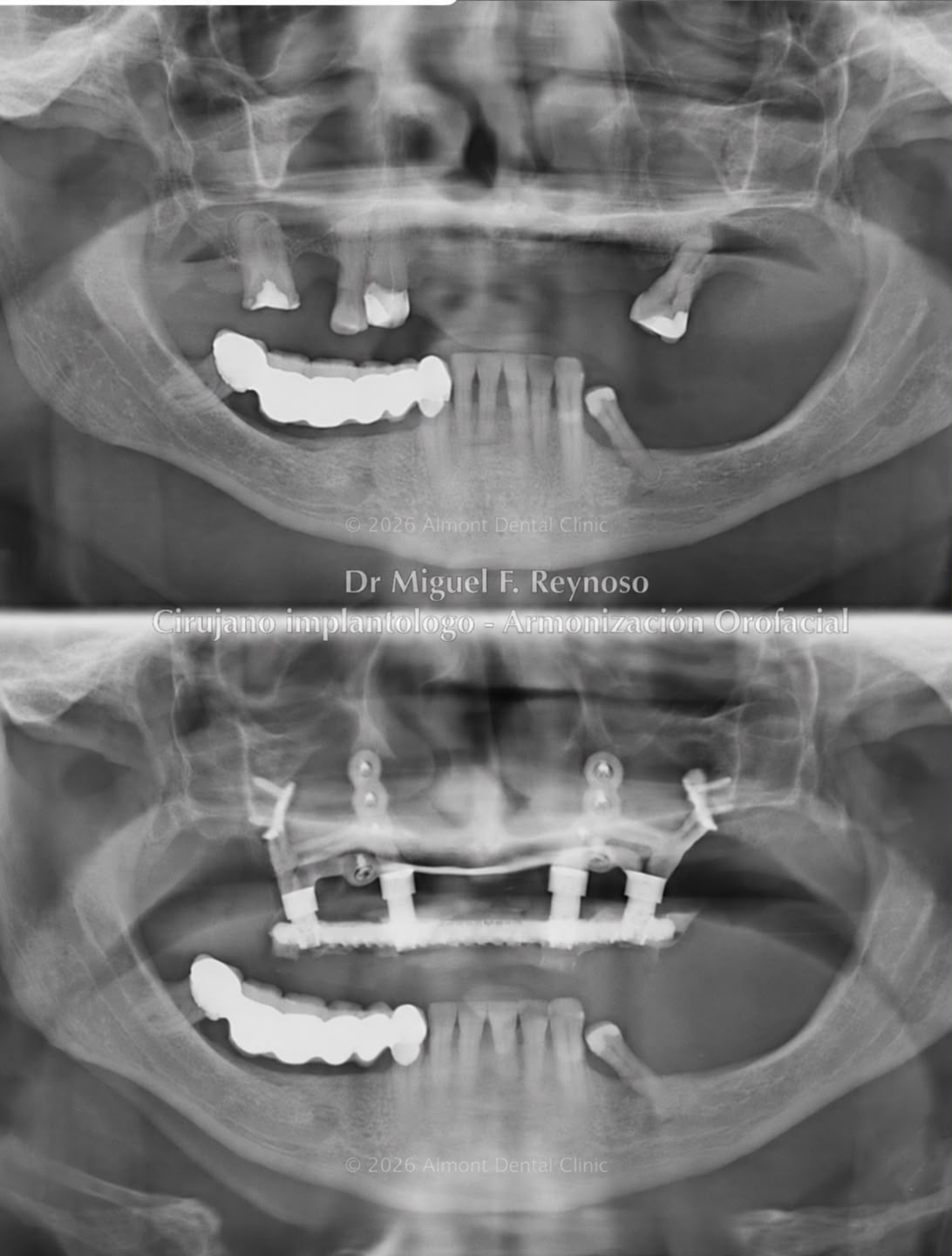 Radiographic comparison of a custom-made implant option