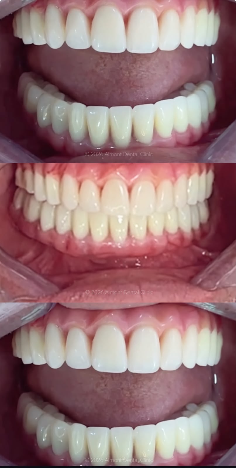 Complete upper and lower full-arch restorations