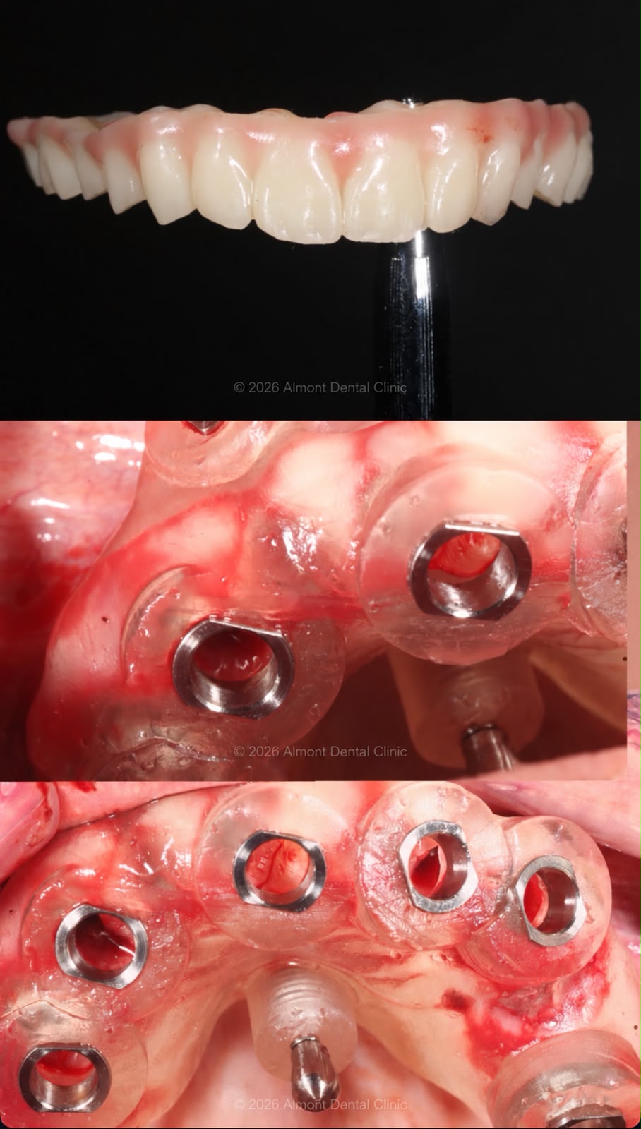 Surgical guides and implant placement