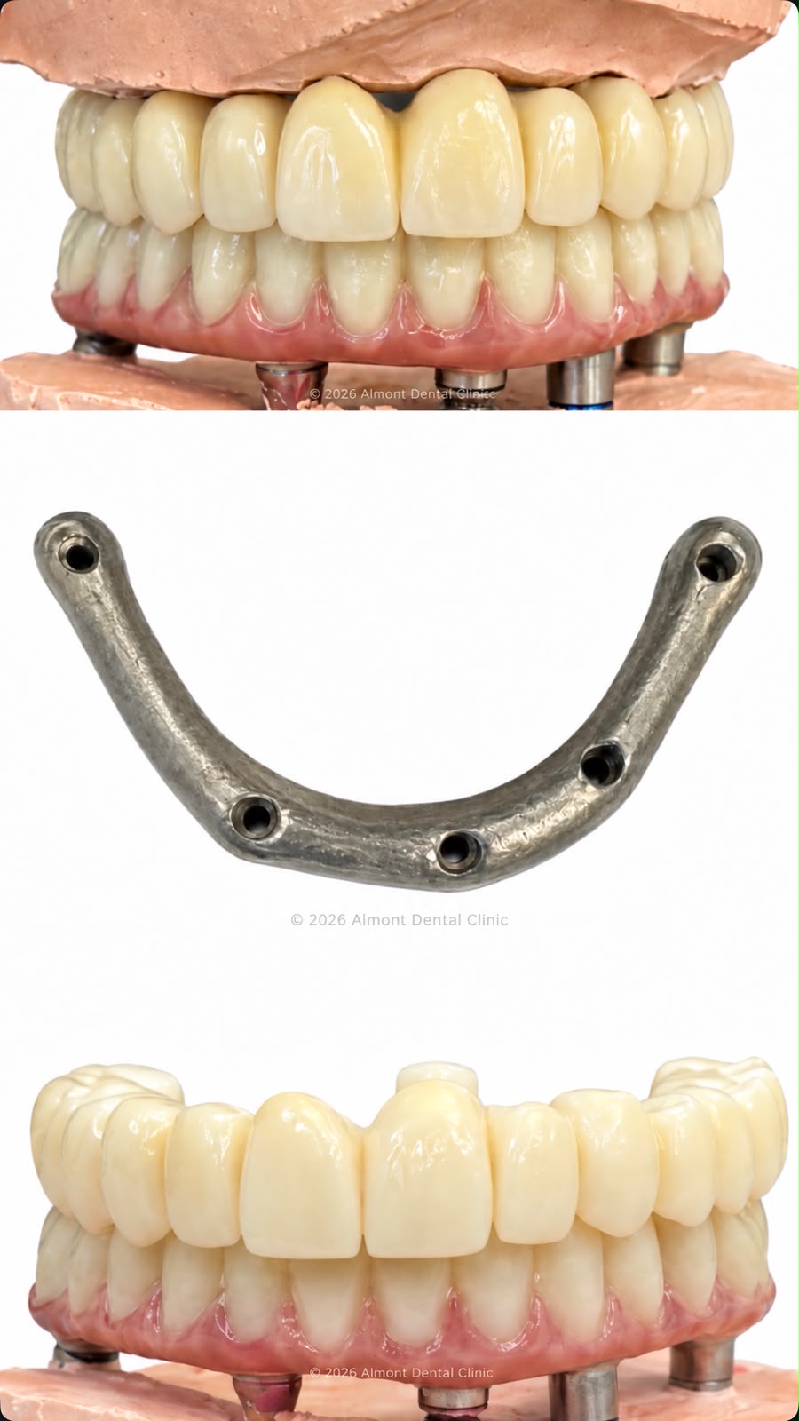 Zirconia full-arch prosthesis and titanium bar